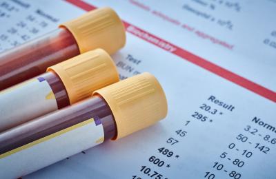 A Safer Therapy for Pulmonary Embolism: Catheter Directed Thrombolysis Shows Promise in New Research