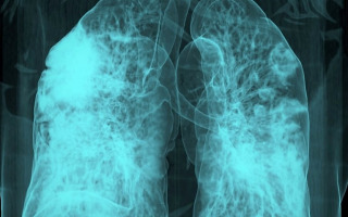 COVID-19’s Lingering Shadow: New Study Uncovers Molecular Link Between SARS-CoV-2 and Lung Cancer Risk