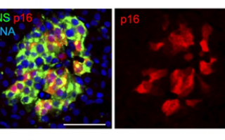 Unveiling Type 1 Diabetes - Secrets of Aging Beta Cells and their Ability to Secrete Insulin