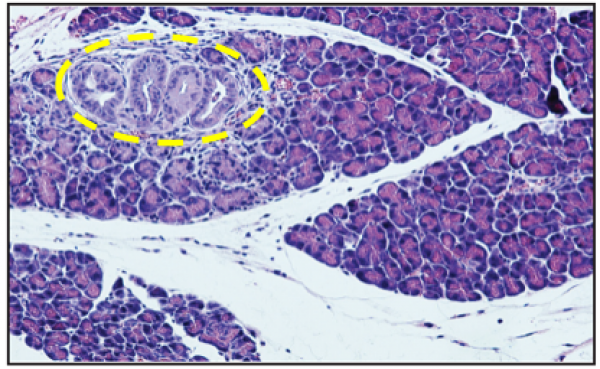 Oral Bacteria Accelerate Pancreatic Cancer Development in Mice: Research Reveals Key Findings