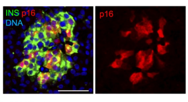 Unveiling Type 1 Diabetes - Secrets of Aging Beta Cells and their Ability to Secrete Insulin